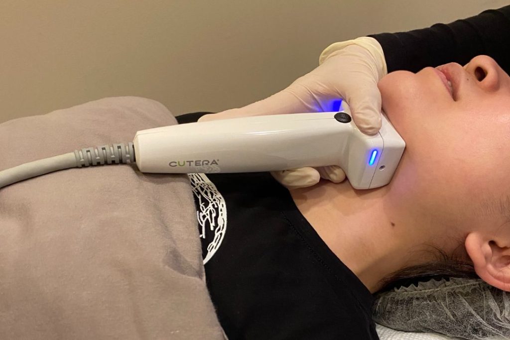 Double chin fat reduction treatment at Veritas Medical Aesthetics
